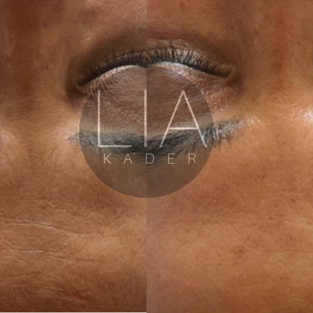 Falten reduzierung by Lia Kader Gesichts-Sculpting-Massage nach LIA